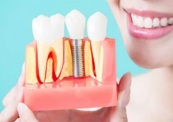 بهترین ایمپلنت اصفهان | ایمپلنت های دندانی