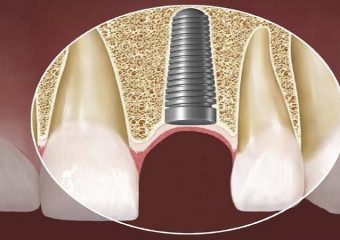 بهترین دندانپزشک اصفهان | ایمپلنت گذاری برای افراد مبتلا به دیابت