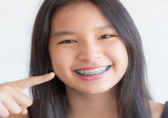 بهترین ایمپلنت اصفهان |بریس دندان کودکان و نکاتی برای آنها