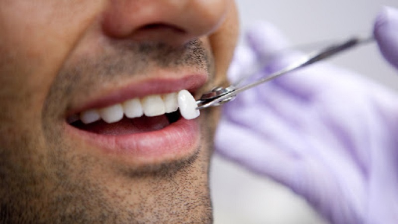 بهترین دندانپزشک اصفهان | روکش لمینت دندان