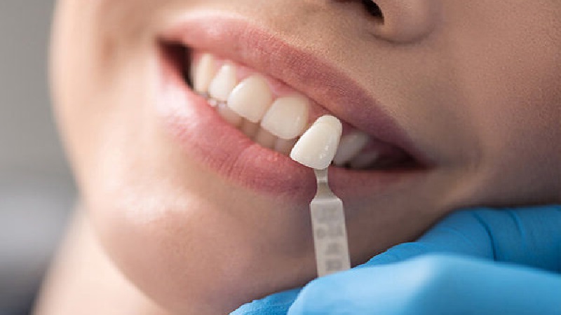 بهترین دندانپزشک اصفهان | لامینت دندان