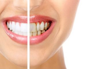 بهترین ایمپلنت اصفهان | وجه تمایز لمینت دندان و بلیچینگ