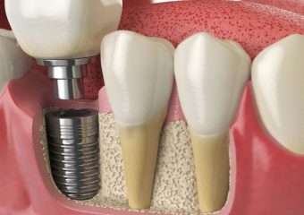 بهترین ایمپلنت اصفهان | کاشت ایمپلنت دندان