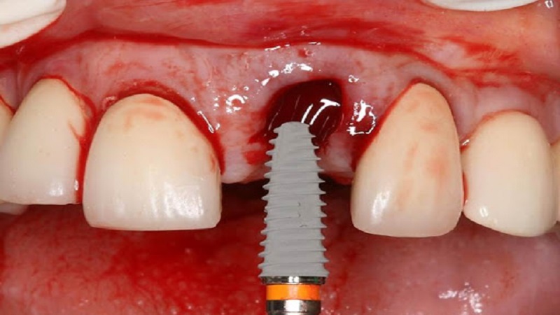 بهترین ایمپلنت اصفهان | از ایمپلنت فوری چه می دانید ؟