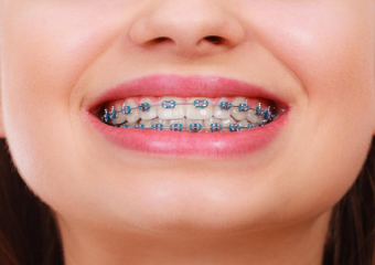 بهترین ایمپلنت اصفهان | تاثیر سیگار بر ارتودنسی دندان