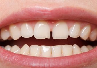 بهترین ایمپلنت اصفهان |درمان فاصله بین دندان ها