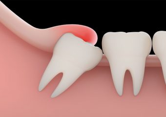 بهترین دندانپزشک اصفهان | دندان عقل