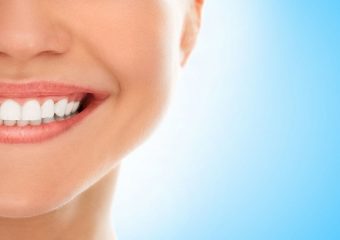 بهترین دندانپزشک اصفهان | روکش کامپوزیت بعد از عصب کشی دندان