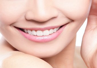 بهترین دندانپزشک اصفهان |شکاف دندان ها