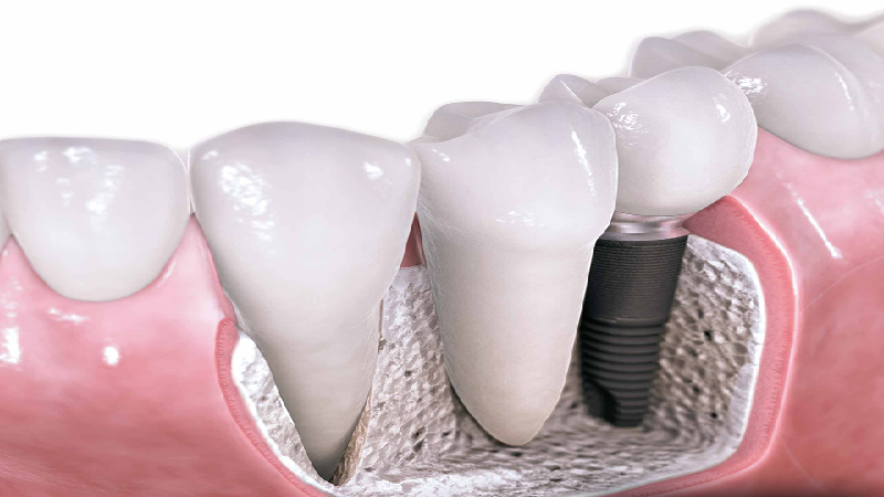 بهترین ایمپلنت اصفهان | شکست ایمپلنت دندان