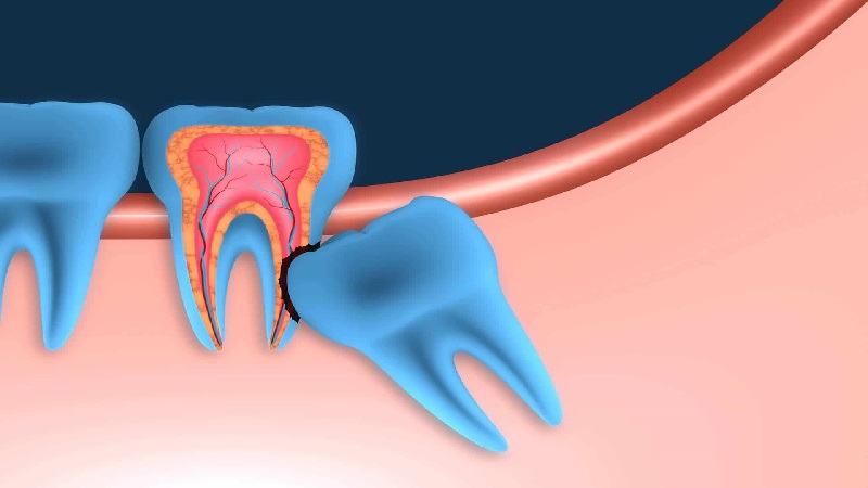 بهترین دندانپزشک اصفهان | عواملی که باعث می شوند دندان عقل را بکشیم