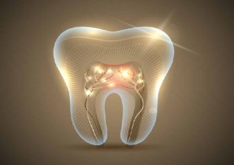 بهترین ایمپلنت اصفهان | فایده درمان ریشه