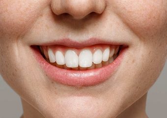 بهترین دندانپزشک اصفهان | 7 راه برای تقویت مینا دندان