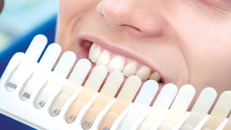 بهترین ایمپلنت اصفهان | برای داشتن روکش کامپوزیت باید چه مراحلی را طی کرد؟