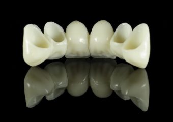 بهترین دندانپزشک اصفهان |بریج دندان .