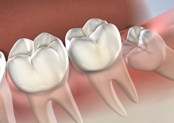 بهترین دندانپزشک اصفهان | بهترین زمان برای کشیدن دندان عقل