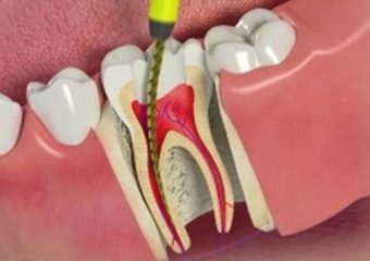 بهترین دندانپزشک اصفهان | روت کانال دندان
