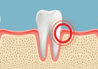 بهترین دندانپزشک اصفهان | علت بروز درد لثه ها چیست ؟