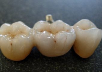 بهترین ایمپلنت اصفهان |پل دندانی