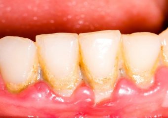 بهترین ایمپلنت اصفهان | بهترین دندانپزشک زیبایی اصفهان | بهترین دندانپزشک اصفهان | بهترین دندانپزشک کودکان اصفهان | پلاک دندان چگونه به وجود می آید ؟