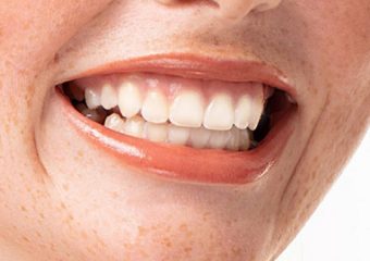 علل لثه بیرنگ | بهترین ایمپلنت اصفهان