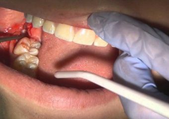 فرآیند جراحی دندان عقل | بهترین ایمپلنت اصفهان