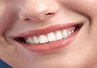 علت لثه بیرنگ | بهترین ایمپلنت اصفهان