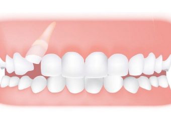 درمان دندان نیش نهفته | بهترین ایمپلنت اصفهان