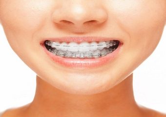 ارتودنسی با دندان پوسیده | بهترین ایمپلنت اصفهان