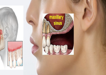 دندان درد سینوسی | بهترین ایمپلنت اصفهان