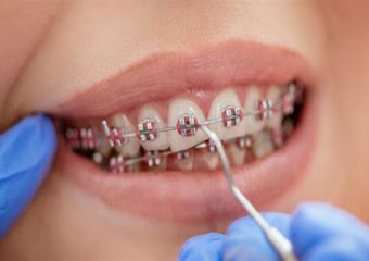 بهترین ایمپلنت اصفهان | بهترین دندانپزشک زیبایی اصفهان | دکتر ندا مکانیک | جلوگیری از پوسیدگی دندان پس از ارتودنسی | بهترین ایمپلنت اصفهان