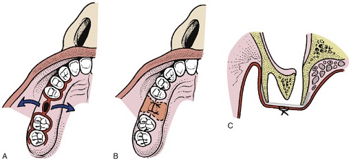 باز شدن سینوس حین کشیدن دندان | بهترین ایمپلنت اصفهان
