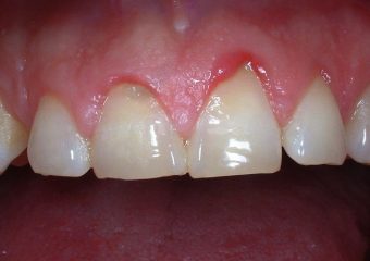 بهترین دندانپزشک اصفهان | تحلیل لثه چیست ؟