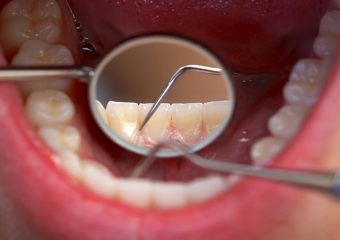 بهترین ایمپلنت اصفهان | سایش دندان ها به چند صورت اتفاق می افتد ؟