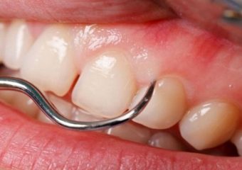 لثه بیرنگ | بهترین ایمپلنت اصفهان