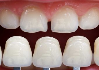 بهترین دندانپزشک اصفهان | ماندگاری و مراحل کامپوزیت دندان