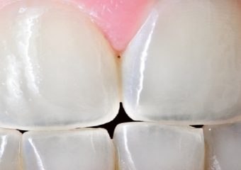 بهترین ایمپلنت اصفهان | محافظت از فرسودگی دندان ها چگونه است ؟