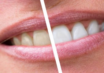 بهترین دندانپزشک اصفهان | مدیریت و درمان پلاک دندان