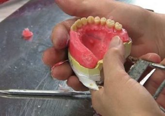 چگونگی ساخت پروتز دندان | بهترین ایمپلنت اصفهان