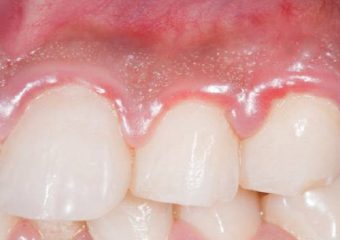 ورم لثه-علائم و راه های درمان آن | بهترین ایمپلنت اصفهان