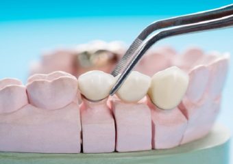 بهترین دندانپزشک اصفهان | پل دندانی درد دارد ؟