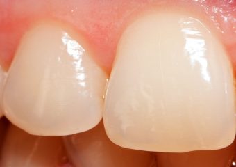 بهترین دندانپزشک اصفهان | چرا ساییدگی دندان رخ می دهد ؟