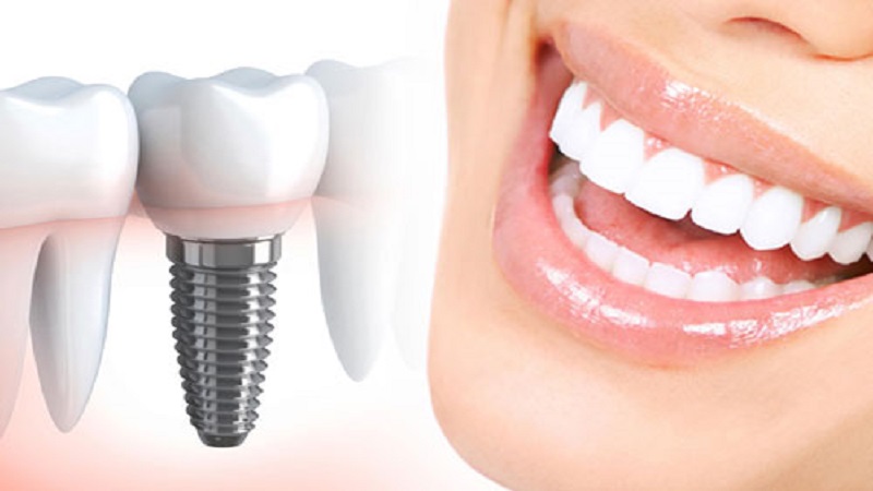 شرایط ایمپلنت دندان چیست؟ | بهترین دندانپزشک اصفهان
