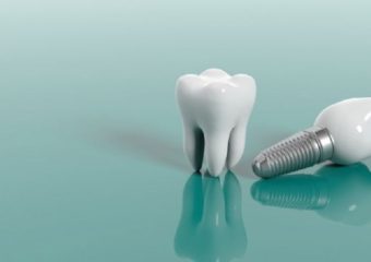 چه کسانی شرایط کاشت ایمپلنت را ندارند؟ | بهترین دندانپزشک اصفهان