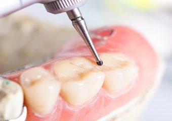 آیا پر کردن دندان خطرناک است؟ | بهترین دندانپزشک اصفهان