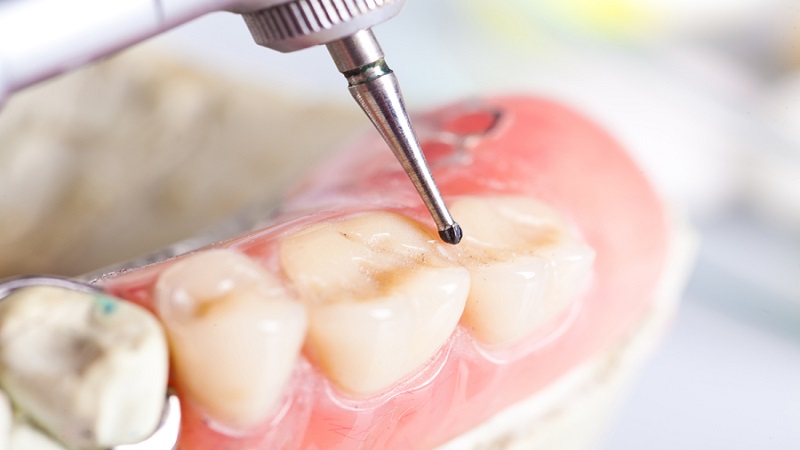 آیا پر کردن دندان خطرناک است؟ | بهترین دندانپزشک اصفهان