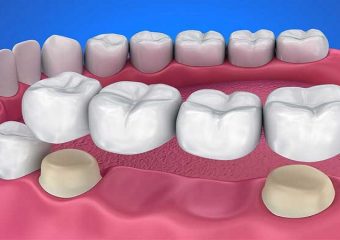 انواع بریج دندان یا پل دندانی | بهترین دندانپزشک اصفهان