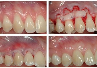 انواع عمل پیوند لثه | بهترین دندانپزشک اصفهان