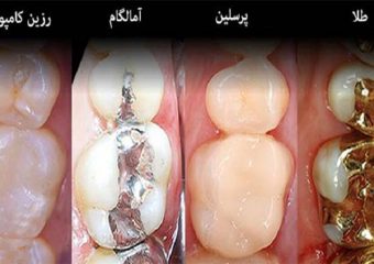 انواع مختلف پر کردن دندان | بهترین دندانپزشک اصفهان