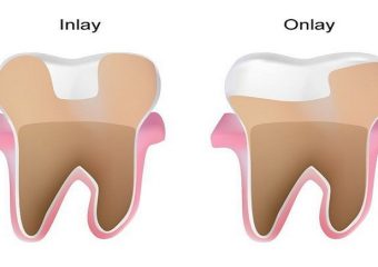 اینله و انله دندان چیست؟ | بهترین ایمپلنت اصفهان